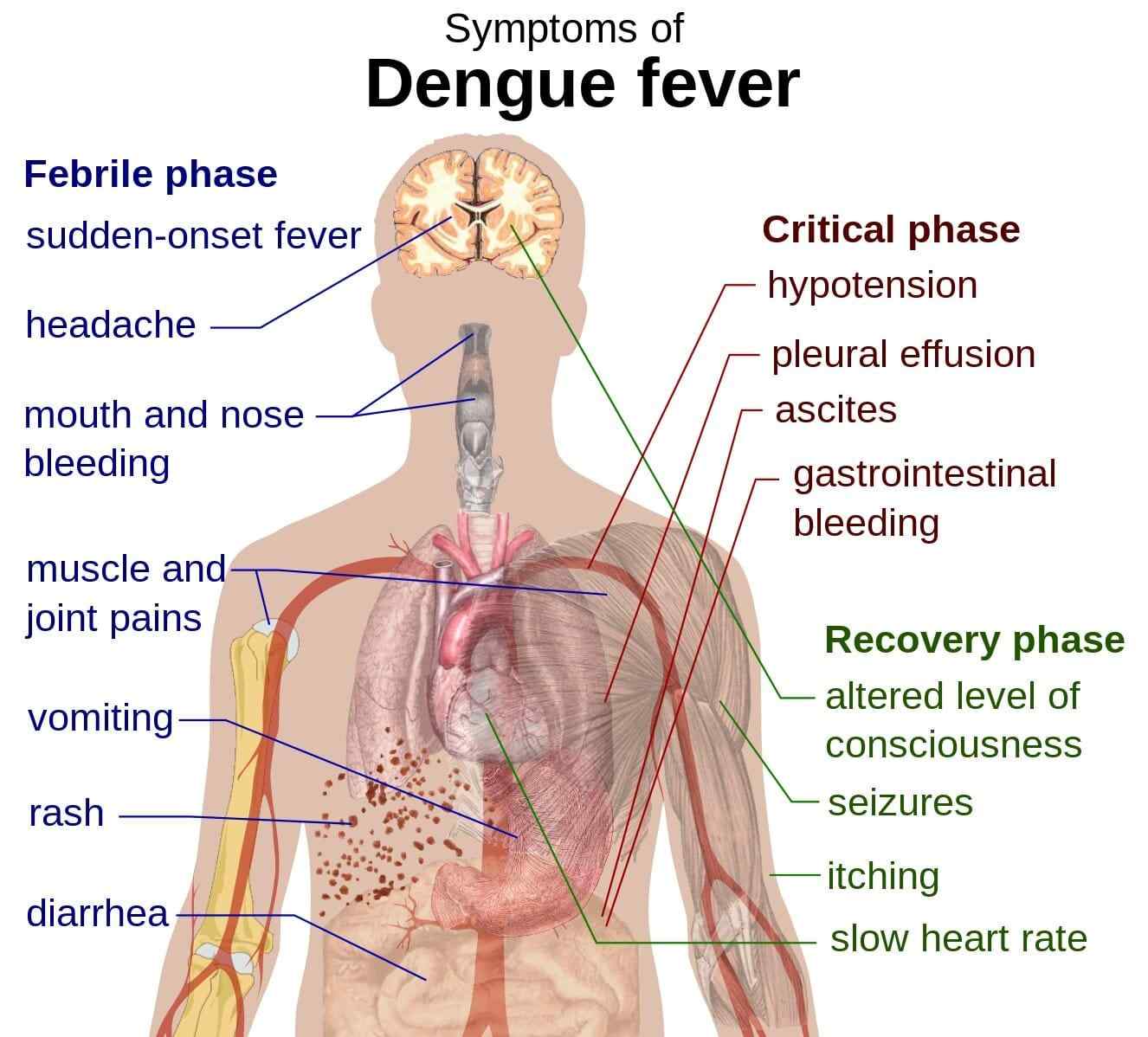 Dengue Fever: Symptoms, Foods To Eat And Avoid